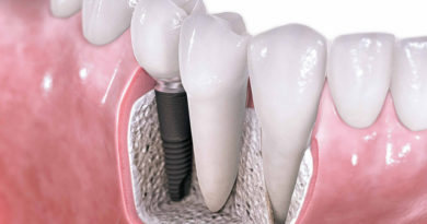 Dentures Vs. Dental Implants
