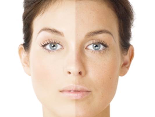 How Does Laser Skin Whitening Work