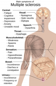 Common Signs of Multiple Sclerosis
