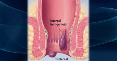 Hemorrhoid Treatments